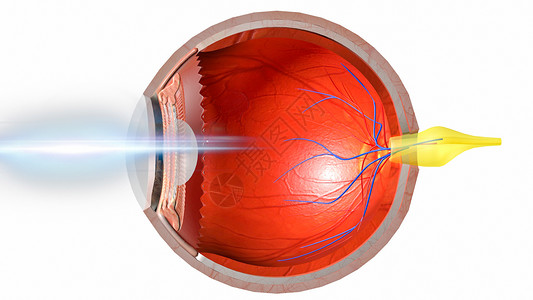 右视网膜近视设计图片
