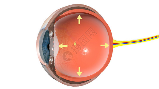 青光眼右侧脉络膜巩膜炎高清图片
