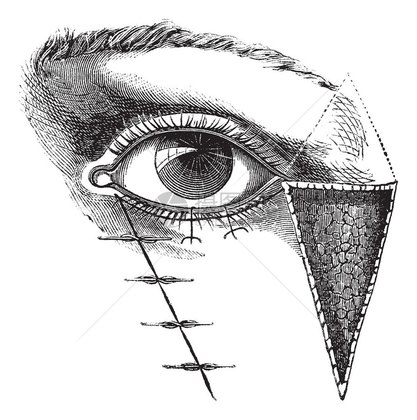 图180Dieffembach方法的眼睑成形术图片