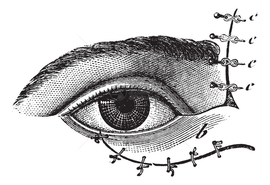 图178Blasius方法的眼睑成形术图片