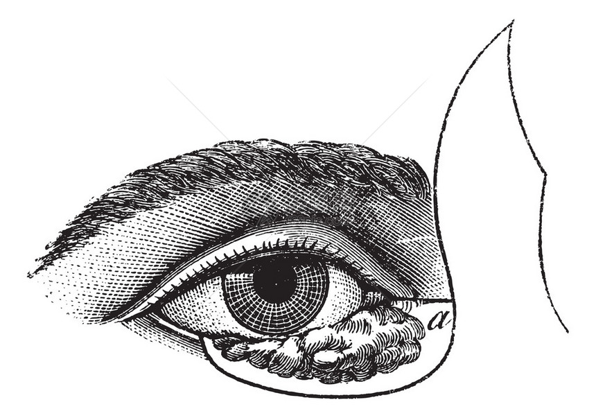图177Blasius方法的眼睑成形术图片