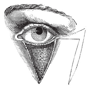 芬迪湾图179Dieffembach方法的眼睑成形术插画