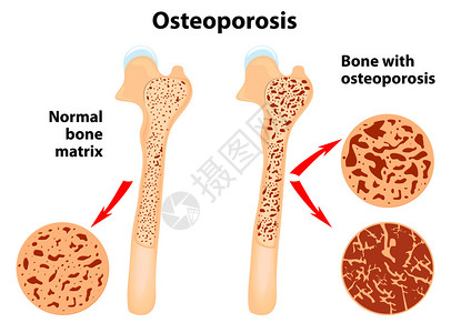 奥索科斯基骨质疏松一种骨骼疾病导致插画