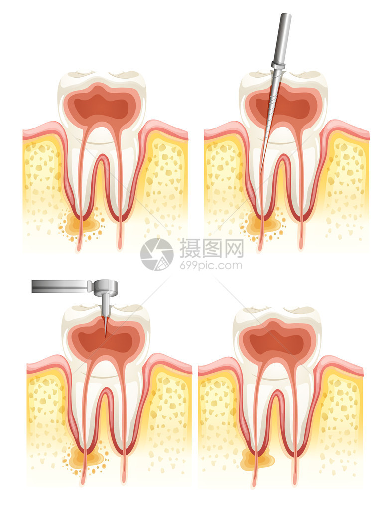 白色背景的牙科根部运河恶化说明图示图片