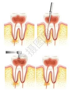 牙髓白色背景的牙科根部运河恶化说明图示插画