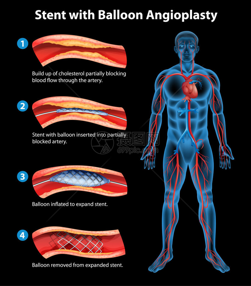 支架血管成形术图示图片