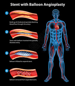 含氧的支架血管成形术图示插画