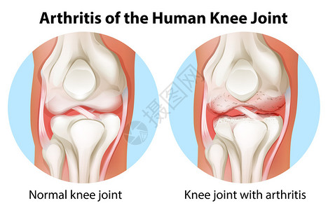 诺沃克白色背景的人体膝关节炎说明插画