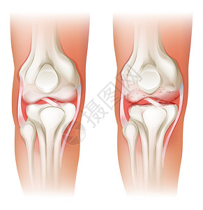 白色背景下人类膝关节炎的插图高清图片