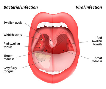 博达哈感染和细菌感染的区别扁桃体张开嘴视图由或细菌感染引起的扁桃体疾病炎插画