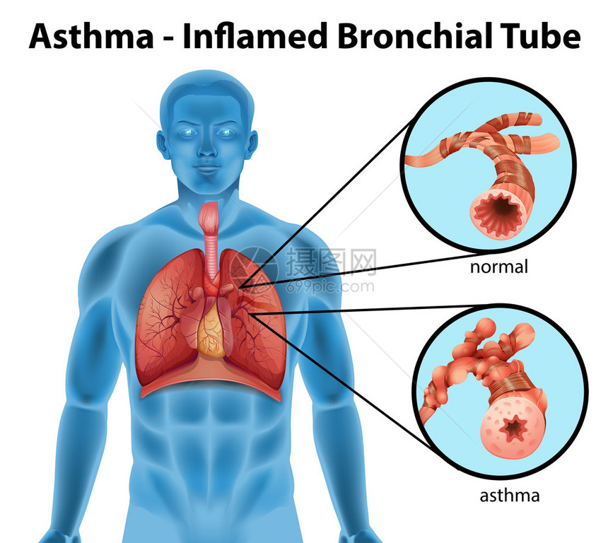 在白色背景上显示哮喘发炎支气管的图像图片