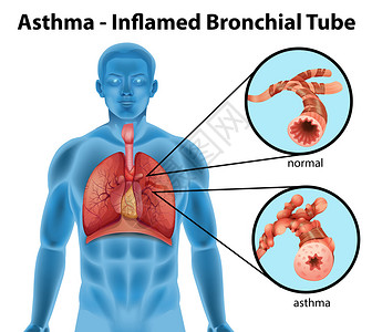 在白色背景上显示哮喘发炎支气管的图像图片