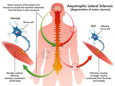 关于ALS症状的医疗说明甲状腺萎缩插画