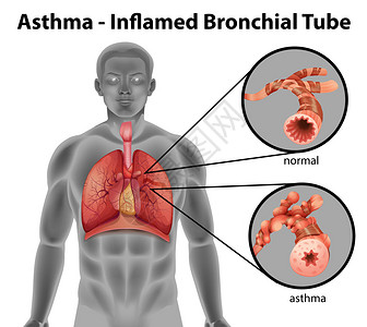 短小白色背景上的哮喘发炎支气管设计图片
