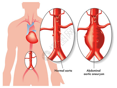 腹主动脉瘤插画