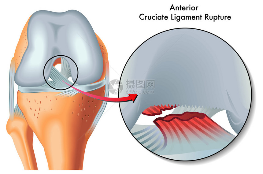 前交叉韧带断裂图片