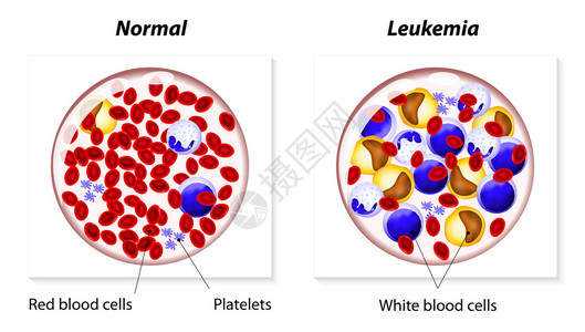嗜酸粒细胞白血病是身体造血组织中的一种癌症插画