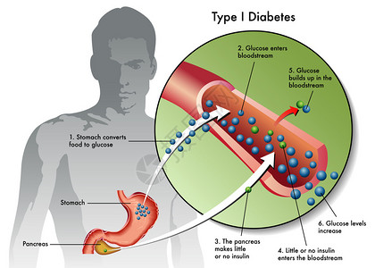 朗格罗型糖尿病标签设计图片