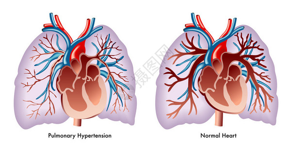 描绘肺动脉高压的艺术品图片