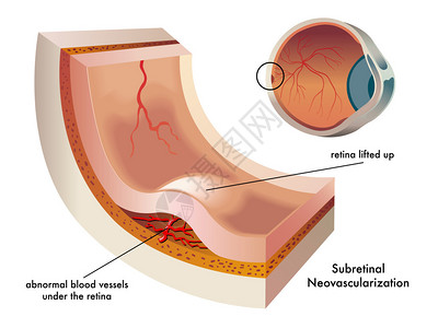 目光性视网膜病变彩色子骨质下新血管化计设计图片