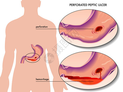 彩色穿孔消化溃疡方案的矢量图解高清图片