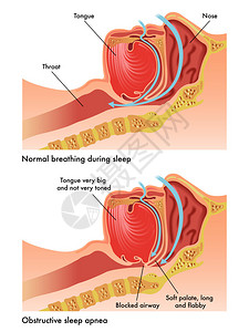 腺样体肥大色彩多的阻碍睡眠睡眠pneasche插画