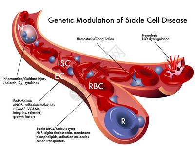 细胞因子白色背景上的镰状细胞病方案设计图片