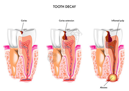 白色背景上的蛀牙解剖图片