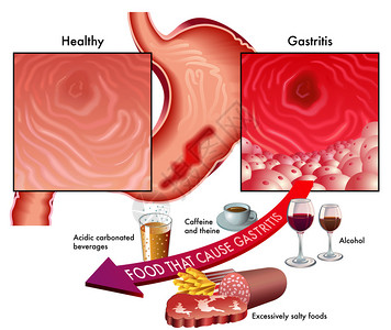 脾胃运化从医学角度说明食胃和食物的症状以避免插画