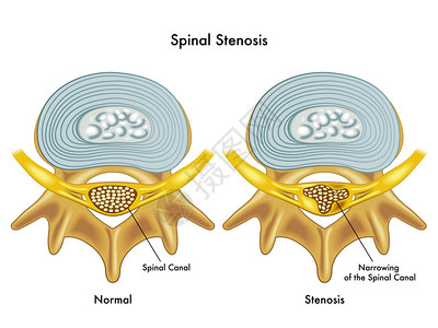 椎间放大倍数从医学角度说明脊椎萎缩插画