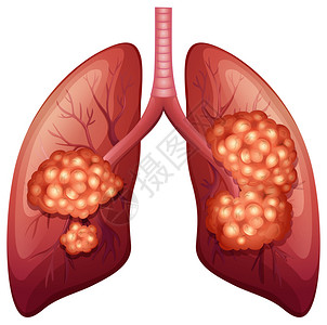 肺癌过程详细说明图片