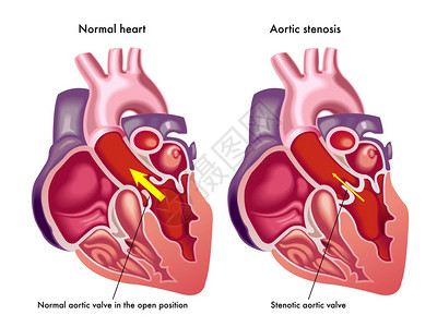 心内膜炎从医学角度来说明凝聚心脏的症状和后插画