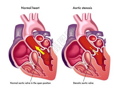 商会从医学角度来说明凝聚心脏的症状和后插画