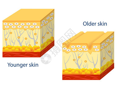 年轻皮肤和老化皮肤的插图显示老年皮肤中的胶原蛋白和破损的图片