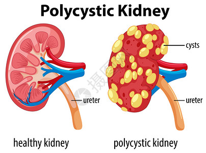 显示多囊肾插图的表高清图片