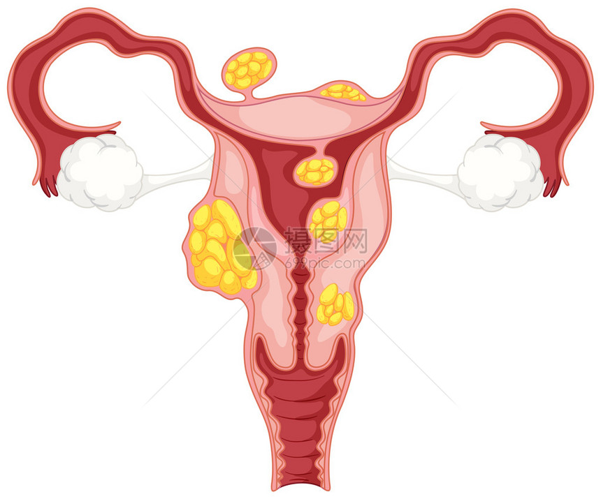 浆膜下子宫肌瘤图解图片