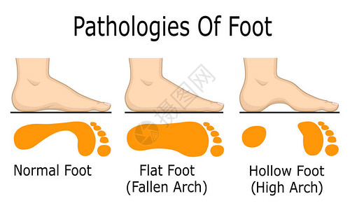 足部病变的图示例如扁平足和空心足图片