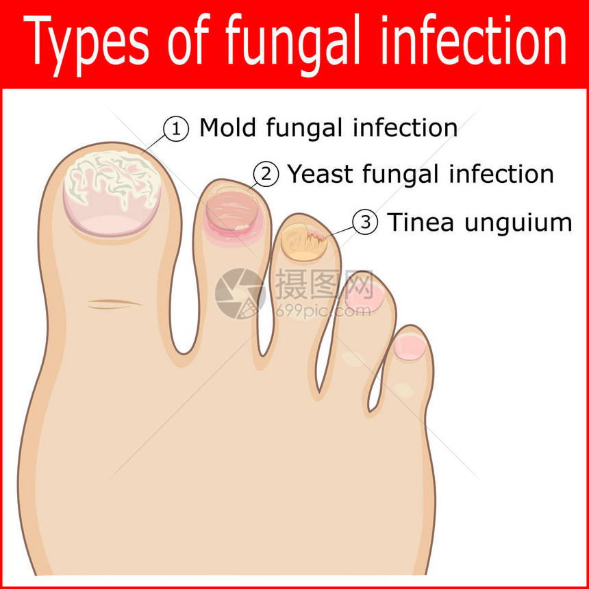 脚趾甲真菌感染的类型图片