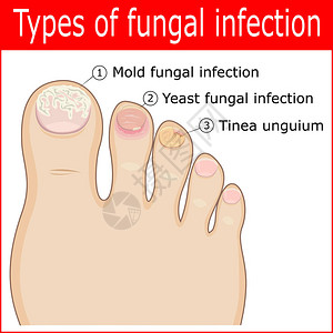 苏瓦脚趾甲真菌感染的类型插画