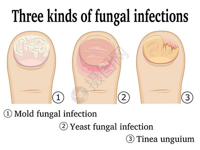 苏瓦脚趾上的三种真菌感染插画