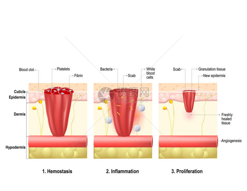 伤口愈合创伤后身体组织修复的过程伤口愈合阶段图片