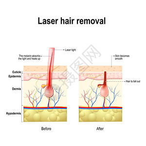 内购会激光除毛激光产生的光束被头发中的色素吸收这会对毛囊造成伤害插画