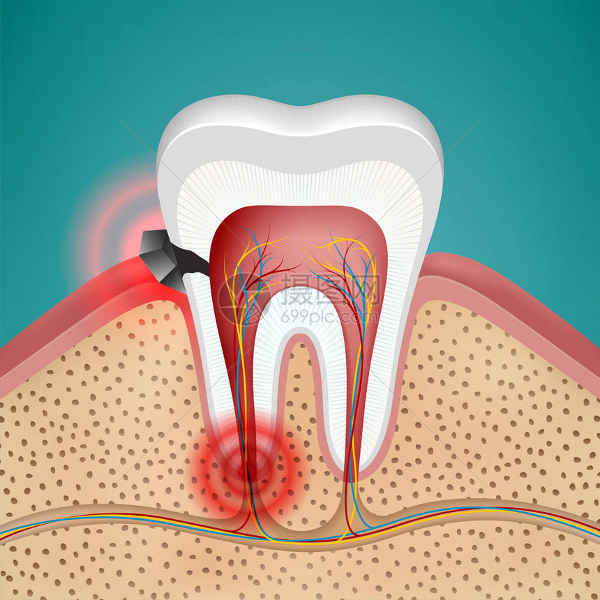 龋齿和疾病牙龈图片