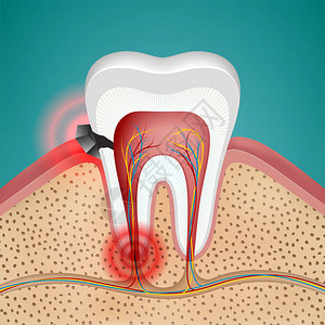 龋齿和疾病牙龈图片