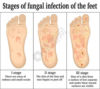 苏瓦涅足部真菌感染的三个阶段插画
