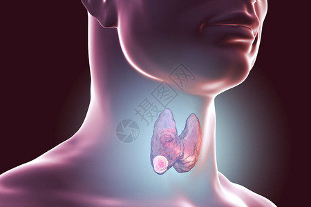 甲状腺癌3D图解显示人体内背景图片