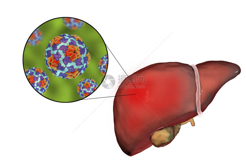 肝炎A感染和对乙型肝炎A的近图片