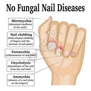 杵状指五种不同的非真菌指甲疾病的插图插画