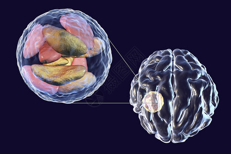 寄生虫原生动物刚地弓形虫引起的脑脓肿和脓肿腔内弓形虫寄生虫的特写视图图片
