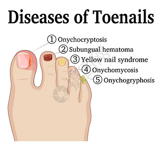 黄脚立在脚趾甲上显示五种不同的指甲疾病插画